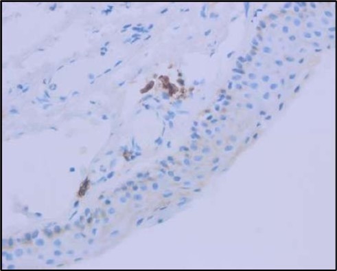OS, Immunohistochemistry using CD138 showing many plasma cells (brown-stained) in the inflamed tissue.