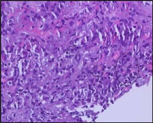 OS, High-power H&E view showing dense inflammatory infiltration within the corneal stroma composed predominantly of lymphocytes and numerous plasma cells (circles highlight plasma cells).