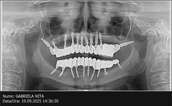 Follow-up panoramic X-ray 09.2025