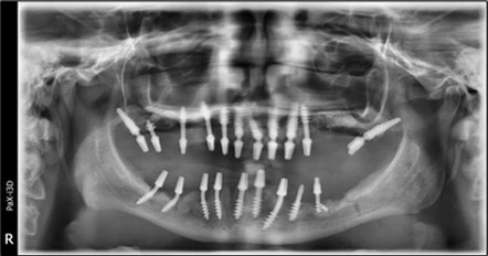 Panoramic pictures after removal of implants affected by peri-implantitis, extractions, alveolar crest regularization, and insertion of corticobasal and TPG implants (07.2022)