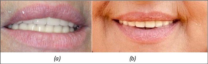 (a) The aesthetic appearance of the patient from the front 4 days. b) 3 years after